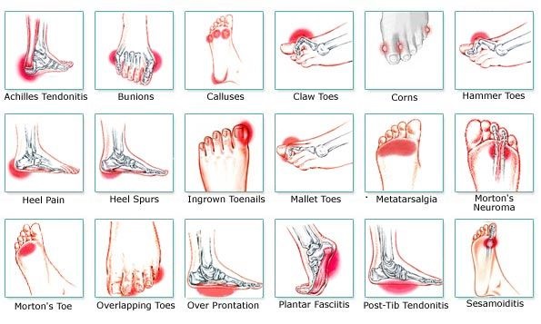 Foot Pain