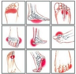 Foot Pain